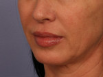 Injectable Fillers Before and after photo