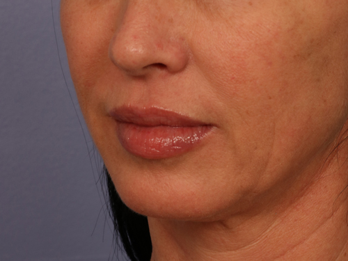 Injectable Fillers before and after photo