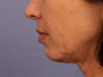 Injectable Fillers Before and after photo