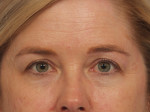 Injectable Fillers Before and after photo