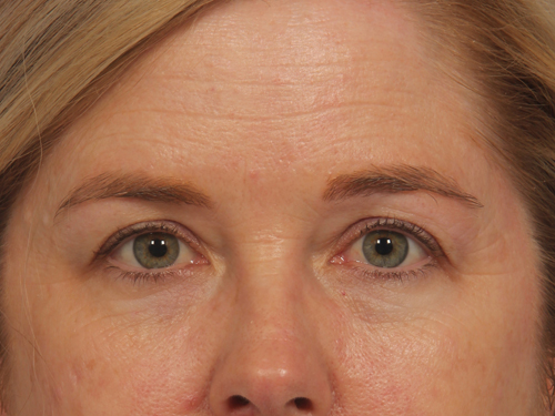 Injectable Fillers before and after photo