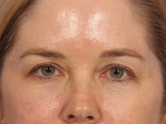 Injectable Fillers Before and after photo