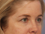 Injectable Fillers Before and after photo