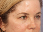 Injectable Fillers Before and after photo