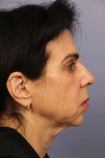 Facelift Before and after photo