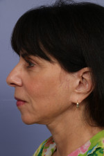 Facelift Before and after photo