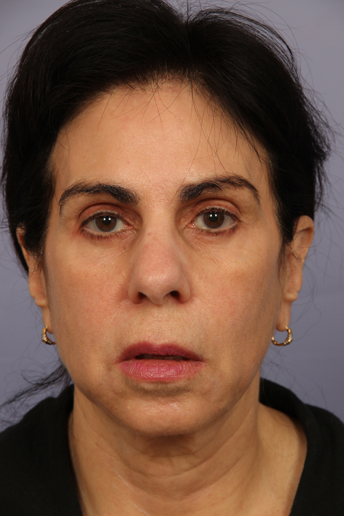 Facelift before and after photo