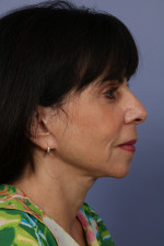 Facelift Before and after photo