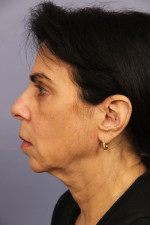 Facelift Before and after photo