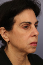 Facelift Before and after photo