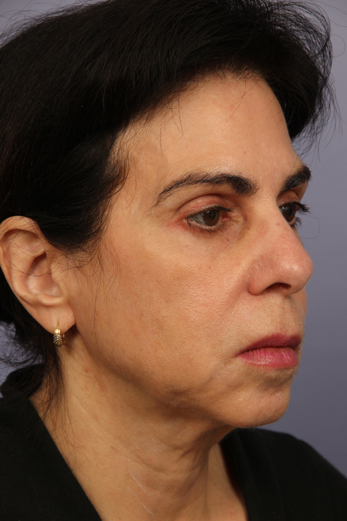 Facelift before and after photo