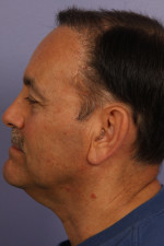 Hair Restoration by NeoGraft® Before and after photo