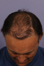 Hair Restoration by NeoGraft®