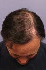 Hair Restoration by NeoGraft® Before and after photo