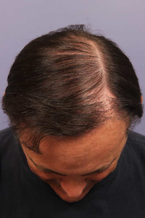 Hair Restoration by NeoGraft® before and after photo