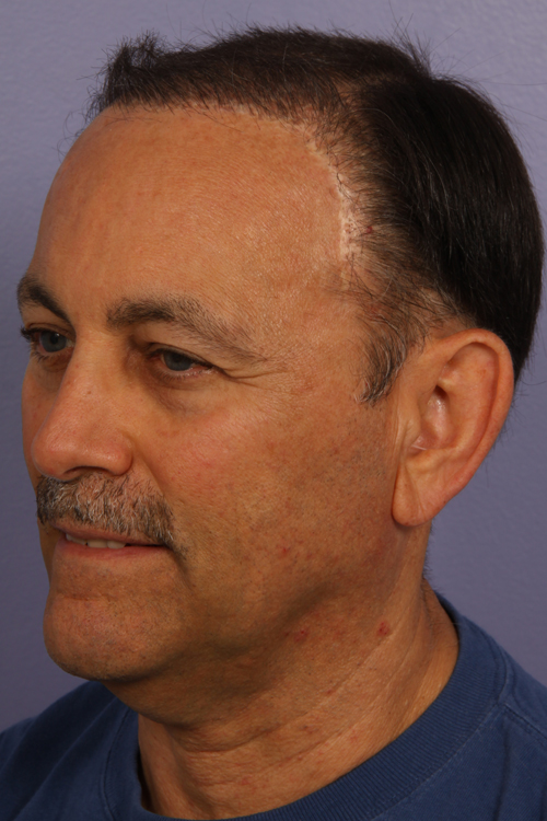 Hair Restoration by NeoGraft® before and after photo