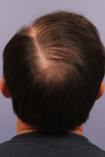 Hair Restoration by NeoGraft® Before and after photo