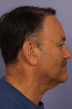 Hair Restoration by NeoGraft® Before and after photo