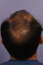 Hair Restoration by NeoGraft®