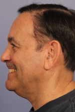 Hair Restoration by NeoGraft® Before and after photo