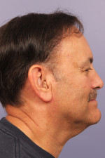 Hair Restoration by NeoGraft® Before and after photo