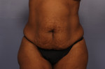 Tummy Tuck Before and after photo