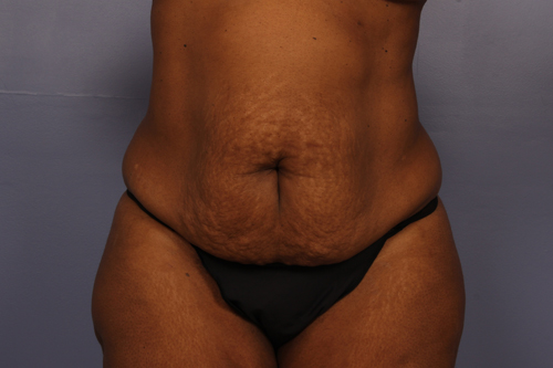 Tummy Tuck before and after photo