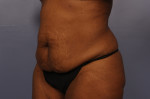 Tummy Tuck Before and after photo