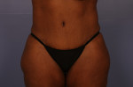 Tummy Tuck Before and after photo