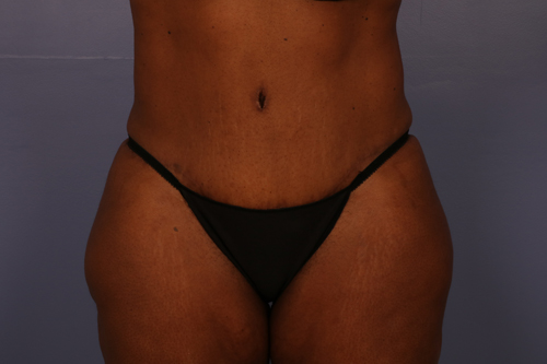 Tummy Tuck before and after photo