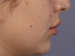 Injectable Fillers Before and after photo