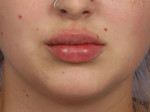 Injectable Fillers Before and after photo