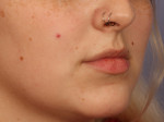 Injectable Fillers Before and after photo