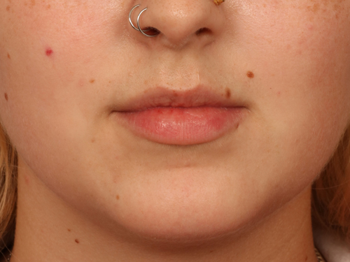 Injectable Fillers before and after photo