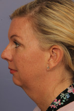 Cheek/Chin Shaping Before and after photo