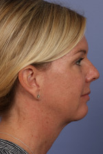 Cheek/Chin Shaping Before and after photo