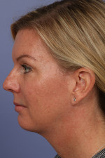 Cheek/Chin Shaping Before and after photo