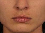 Lip Augmentation Before and after photo