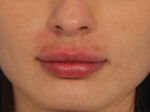 Lip Augmentation Before and after photo