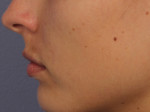 Lip Augmentation