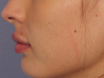 Lip Augmentation