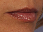 Injectable Fillers Before and after photo