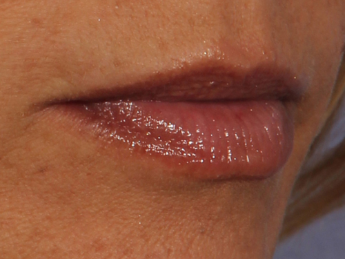Injectable Fillers before and after photo