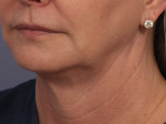 Kybella