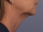 Kybella