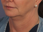 Kybella