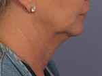 Kybella