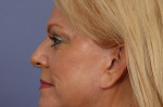 Eyelid Surgery Before and after photo