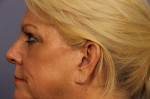 Eyelid Surgery