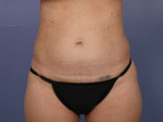 Tummy Tuck Before and after photo